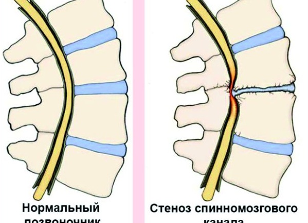 ПОЗВОНОЧНИК - СТЕНОЗ ПОЗВОНОЧНОГО КАНАЛА - причины, симптомы, диагностика, лечение